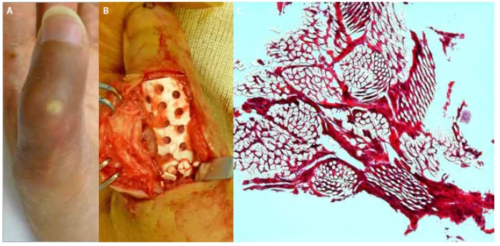 Photographs of the left thumb of a 22-year-old patient (case 1). <br> 
 A) Macroscopic view; B) operative finding;
C) histological finding.