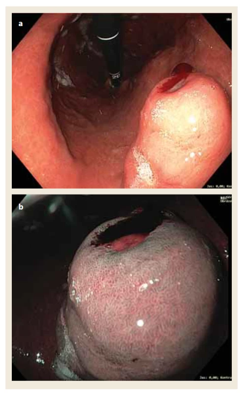 Tumor žaludečního antra v oblasti malé kurvatury
charakteru subepiteliálniho útvaru s povrchovou ulcerací:
a) vyšetření v bílém světle; b) vyšetření v NBI modu.<br>
Fig. 2. Subepithelial tumour with superficial ulcer localized in
gastric antrum on lesser curvature: a) white light; b) narrow
band imaging.