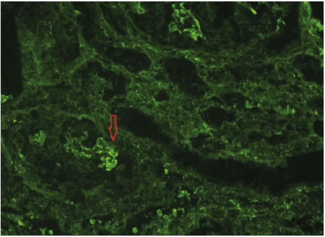 Lineární závojovitá pozitivita IgG na GBM (imunofluorescence), archiv autorů