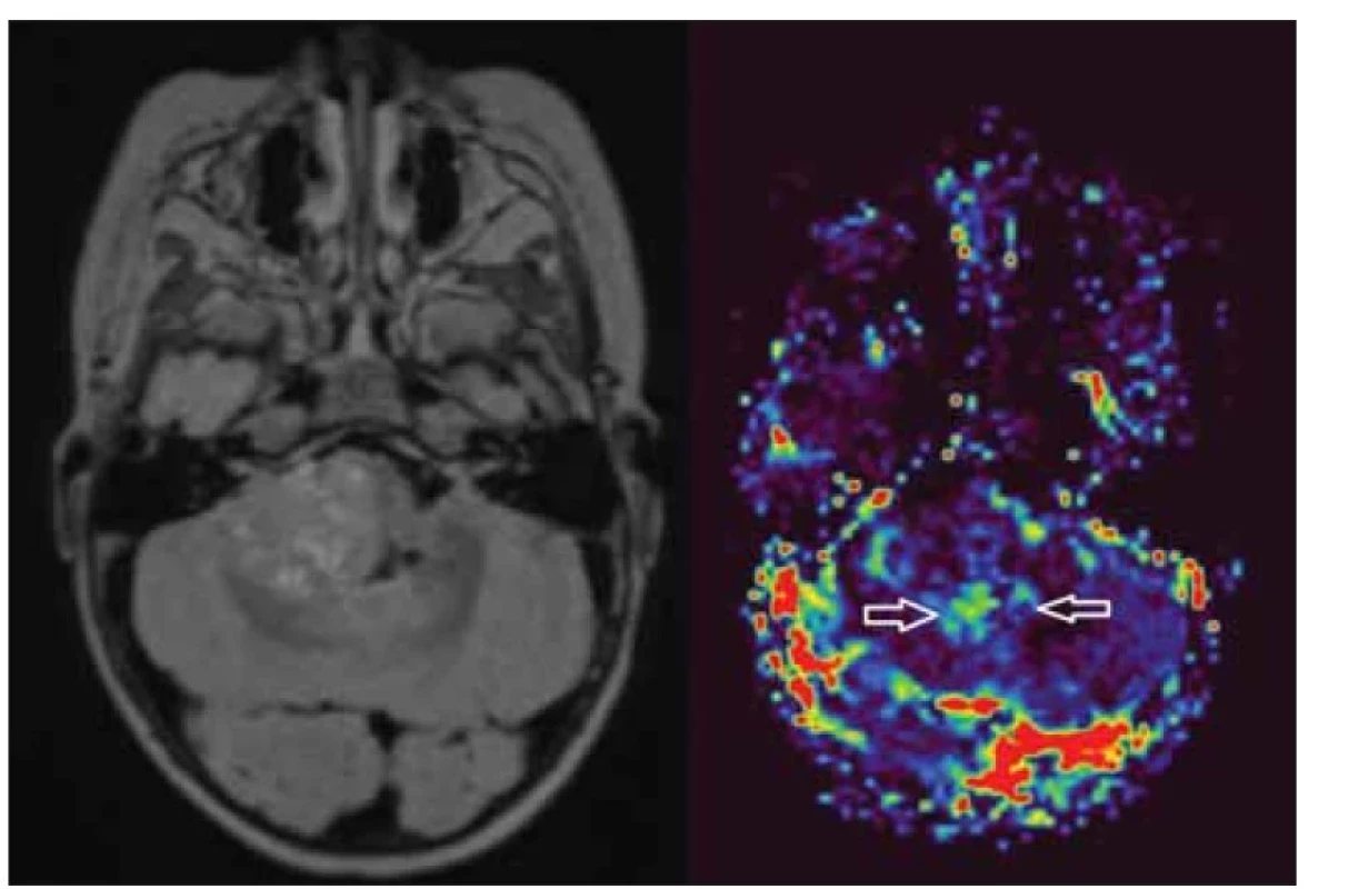 Elevace objemu krve v mozkové tkáni u tumoru zadní jámy svědčí agresivnímu
procesu.<br>
Fig. 8. Elevation of cerebral blood volume in a posterior fossa tumour indicates an
aggressive process.