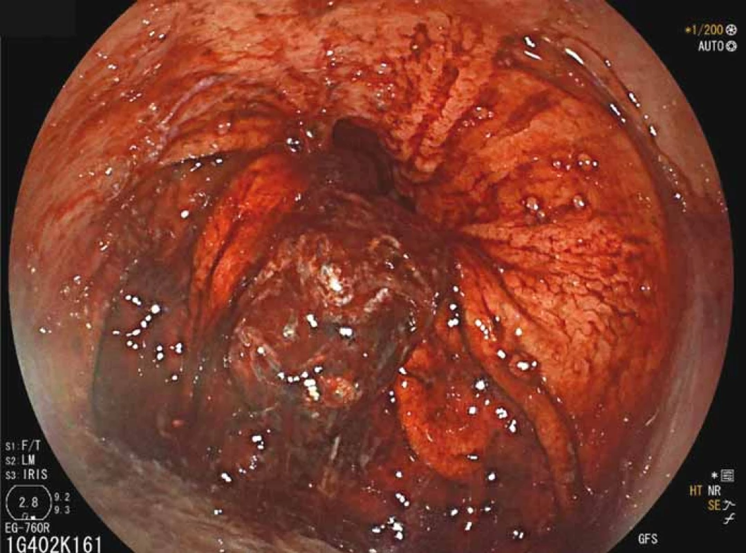 Endoskopický pohled – krvácení z hiátové hernie, krevní koagulum
v místě Cameronova vředu.<br>
Fig. 5. Endoscopic view – bleeding from hiatal hernia, a clot located at the site
of Cameron’s ulceration.