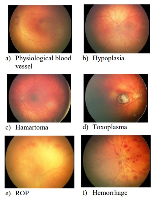  Representative sample of retinal images taken
by RetCam3 with specified diagnosis by the clinical
specialist ophthalmologist in our dataset.