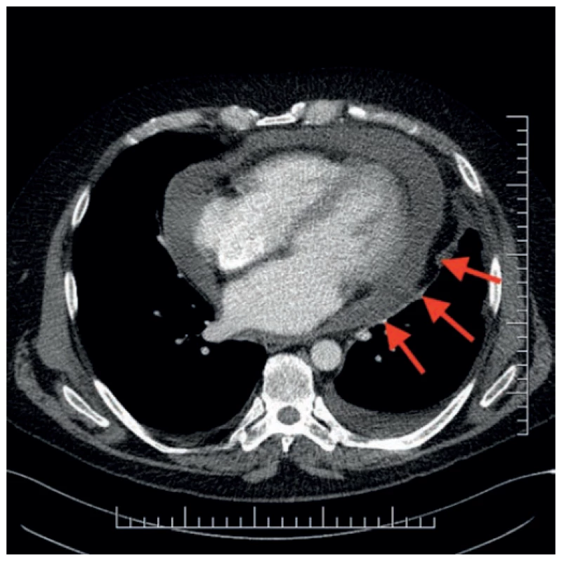 Fluidoperikad na CT hrudníka<br>
Fig. 4. Pericardial eff usion on a chest CT scan