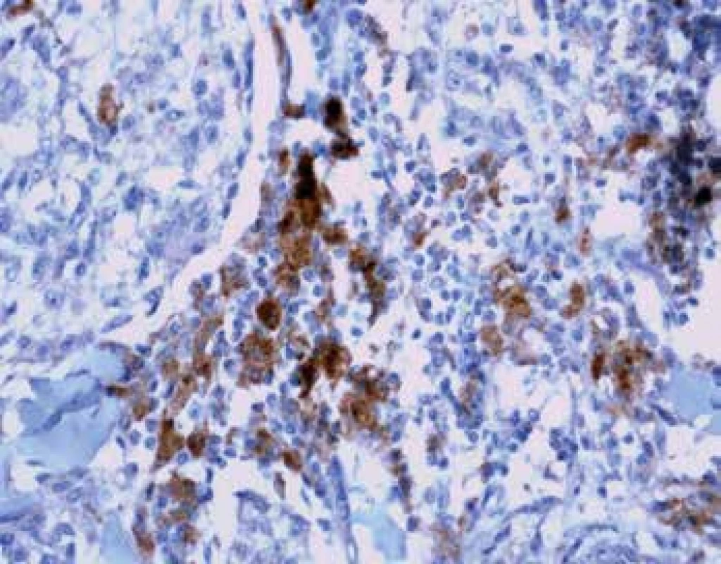 Imunohistochemický průkaz protilátky anti-PD-L1 v tumor infiltrujících
lymfocytech na periferii tumoru (zvětšení 200x).