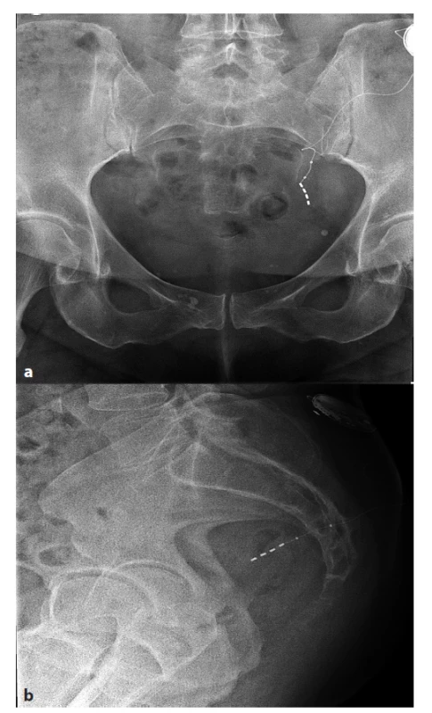 a, b: Dislokovaná elektroda v předozadní a boční
projekci<br>
Fig. 5 a, b: Displacement of electrode in X-ray sacrum AP
and lateral view