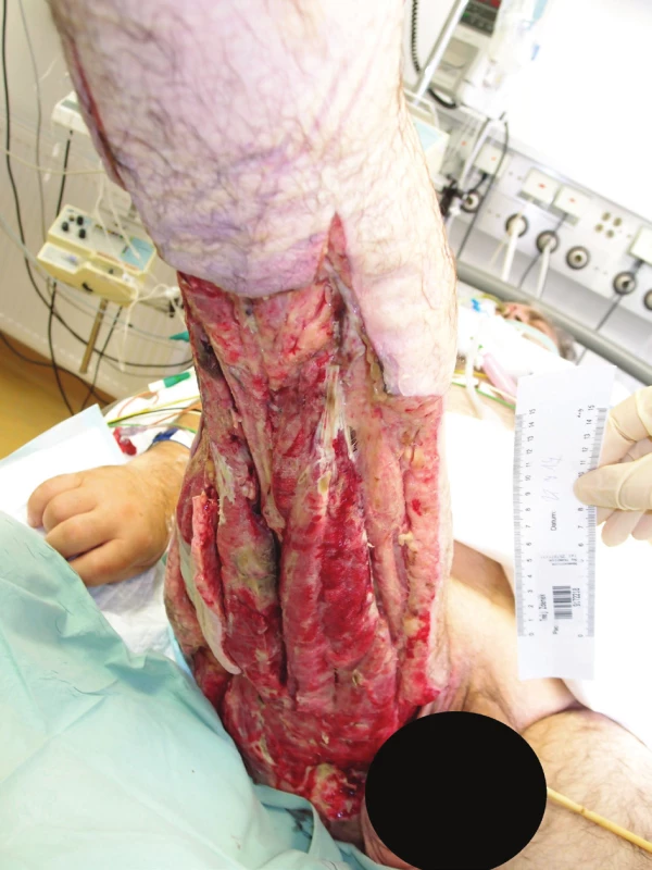 Rozsáhlý defekt po nekrektomiích na pravé dolní
končetině (18. 7. 2017)<br>
Fig. 5: Extensive defect after necrectomies on the right
lower extremity