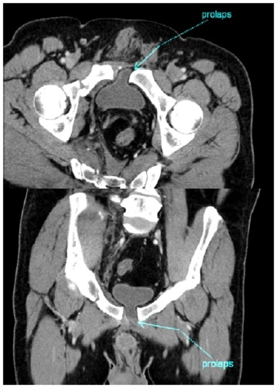 Prolaps močového měchýře do rozestupu
symfýzy, značeno modrou šipkou <br> 
Fig. 3. Urinary bladder prolapse into a ruptured pubic
symphysis, marked with a blue arrow
