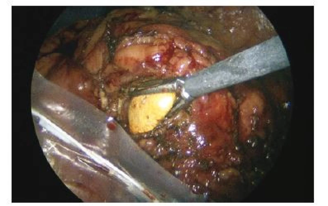 Extrakcia konkrementu z incidovaného ľavého
pyelonu, pomocou grasperu následne presunutie do
zberného vrecka<br>
Fig. 3. Stone extraction from incised left pelvis of horseshoe
kidney using grasper and the placement into the
Endobag