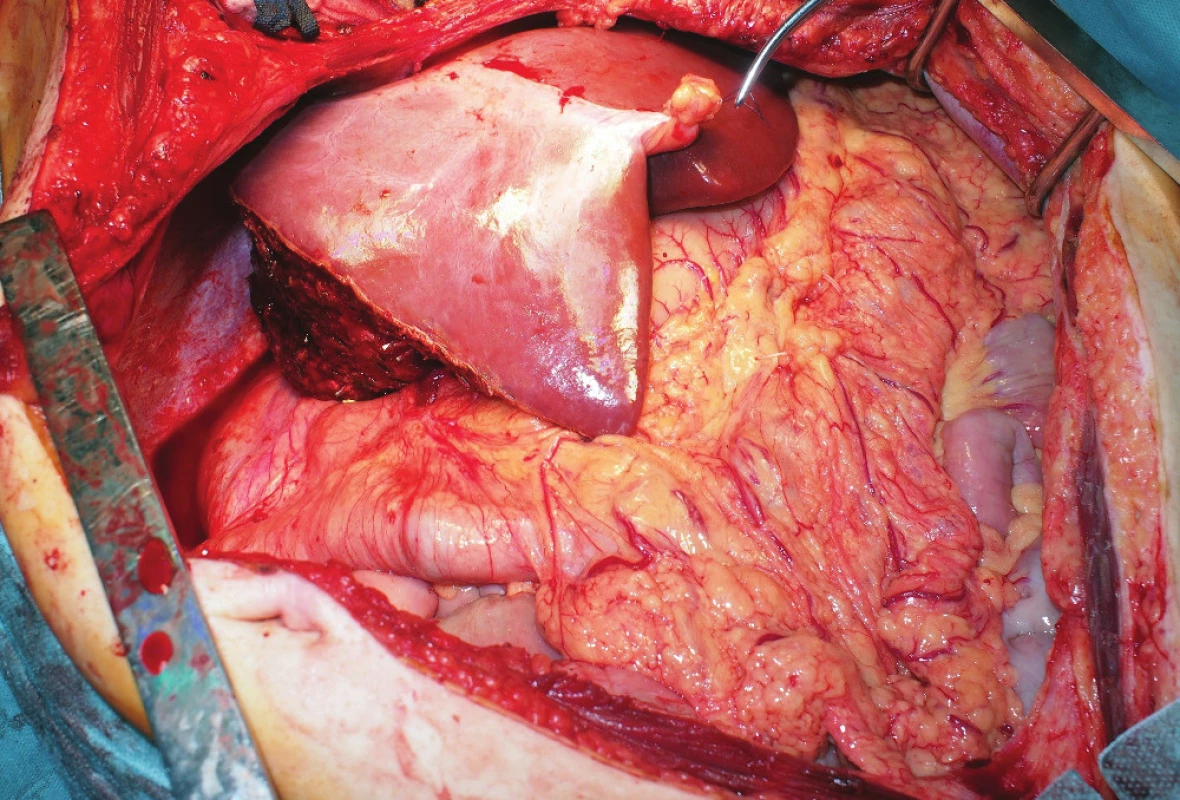 In situ-reduced left hemi-liver graft during the procurement
period
