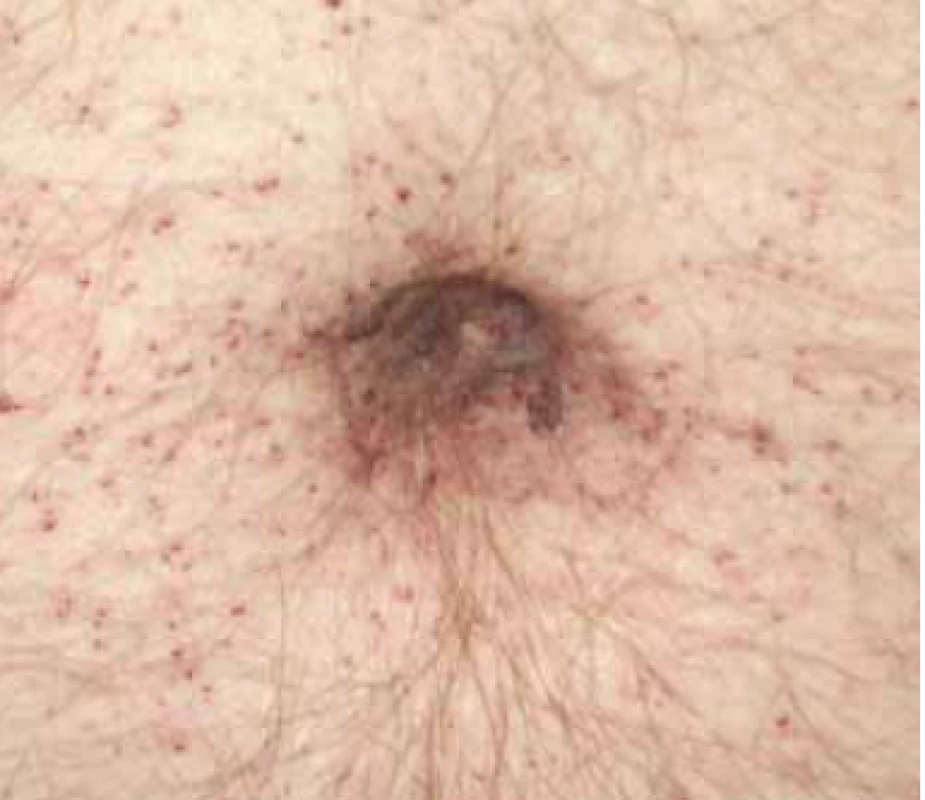 a. Angiokeratomy kůže u pacienta
s Anderson-Fabryho chorobou.<br>
Fig. 1.a. Angiokeratomas of the skin in
a patient with Anderson-Fabry disease.