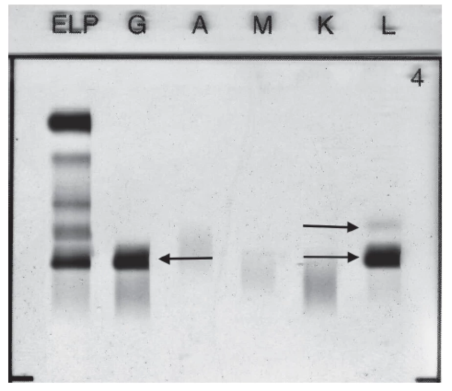 Immunofixation electrophoresis of patient´s pleural
fluid sample presenting paraprotein IgG Lambda and FLC
Lambda.