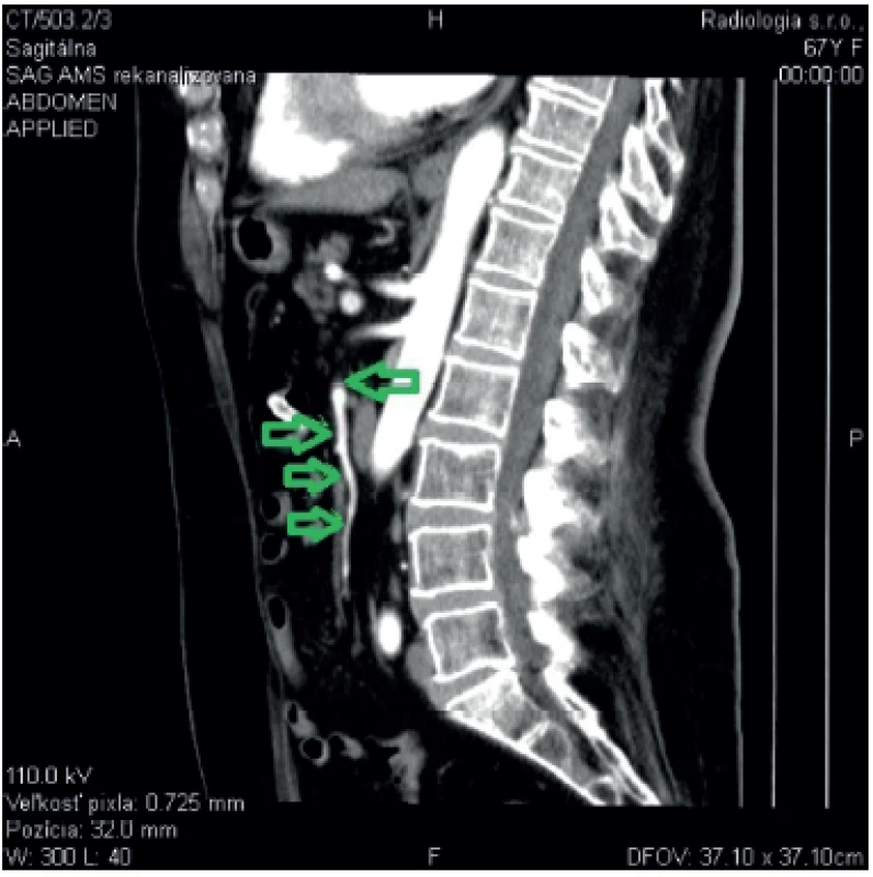 Complete recanalization of the superior mesenteric artery