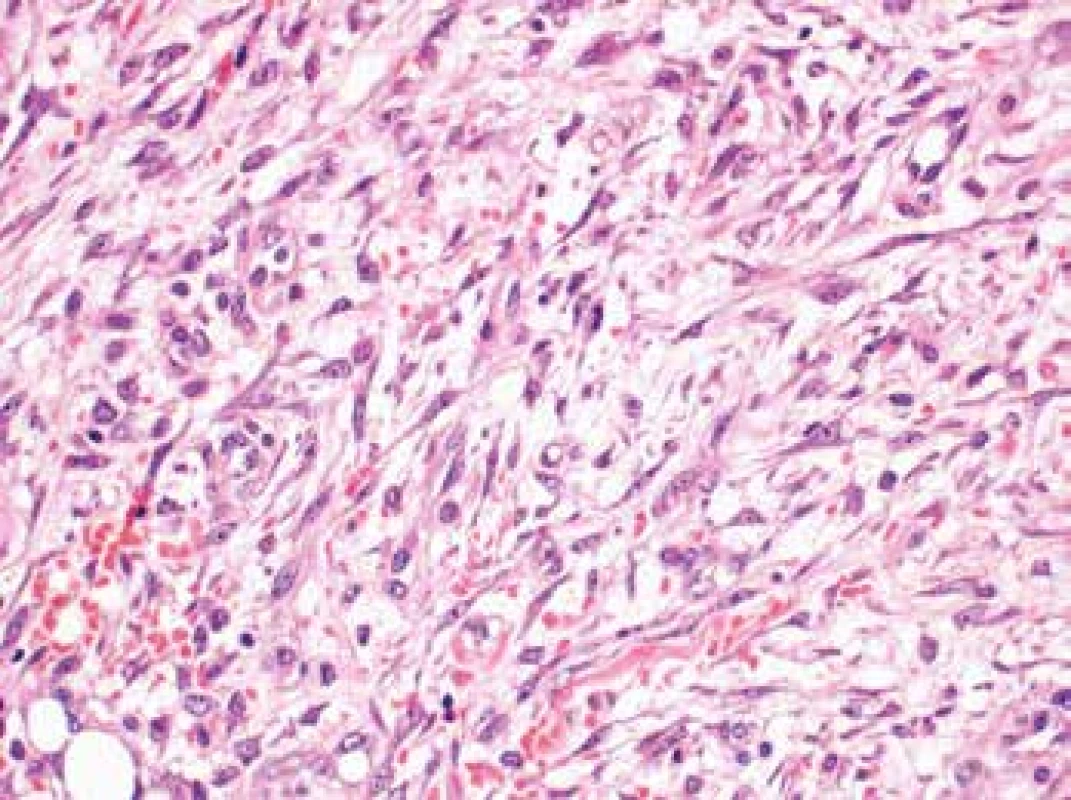 The lesion composed of plump spindle or stellate cells arranged in
a subtle fascicular pattern (H&E, original magnification 400x).