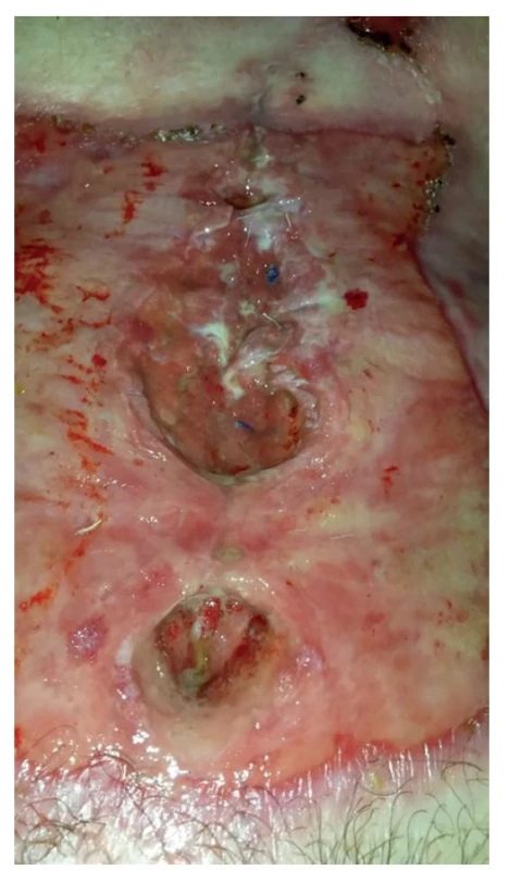 Parciální dehiscence laparotomie<br>
Fig. 4: Partial dehiscence of laparotomy