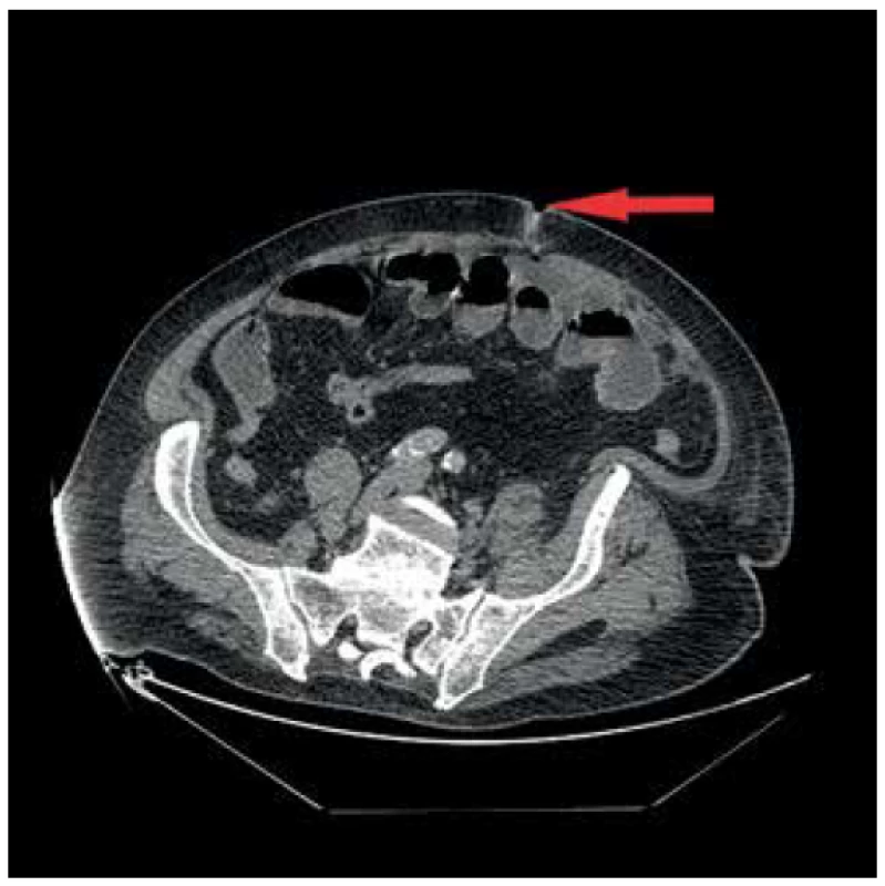 Enteroatmosférická píštěl na proximálním jejunu<br>
Fog. 1. Enteroatmospheric fistula on proximal jejunum