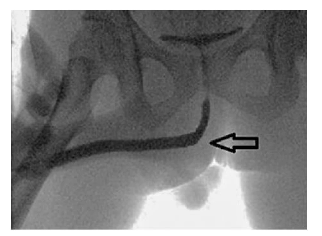 MUCG tři měsíce od operace: uretra bez striktury
a bez patologické extravazace kontrastní látky
v oblasti po extirpaci cysty spongiózy bulbu (šipka)<br>
Fig. 7. VUCG three months after surgery: the urethra
with no stricture and no pathological extravasation
of the contrast medium in the area after extirpation
of the cyst in the spongy body (arrow)