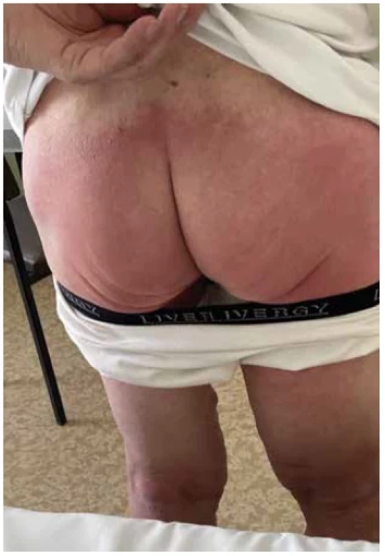 Charakteristický symetrický ostro ohraničený erytém
v gluteálnej oblasti