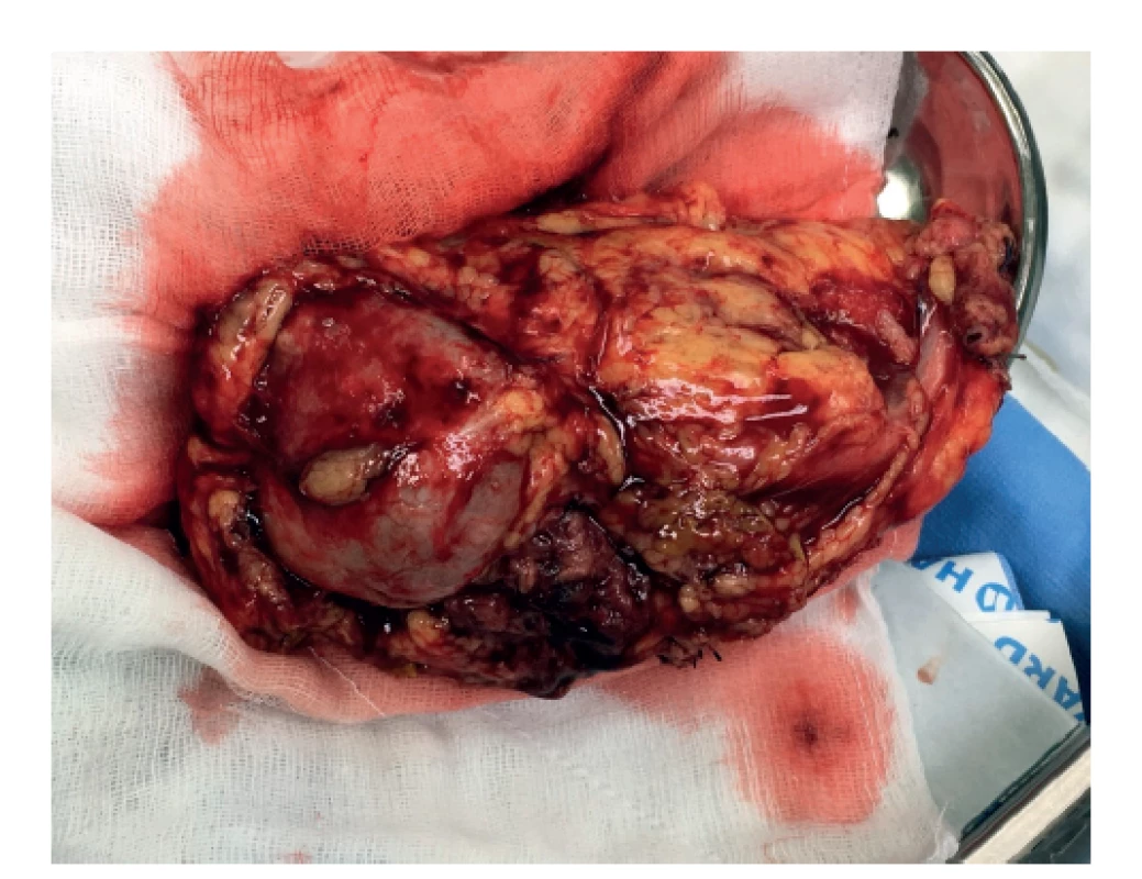Resekát pravej obličky s tumorom<br>
Fig. 6: Right kidney resection with the tumor