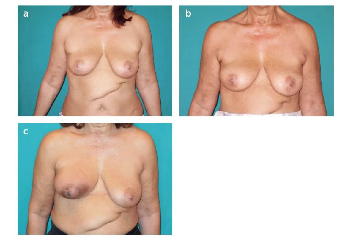 Patient with lower outer quadrant cancer of the right
breast. Quadrantectomy, sentinel lymph node biopsy and
reconstruction with LICAP flap were performed.
A: Preoperative view. B: One moth postoperative view.
C: Result after radiotherapy (loss of volume, shrinkage of the flap
and radiodermatitis)