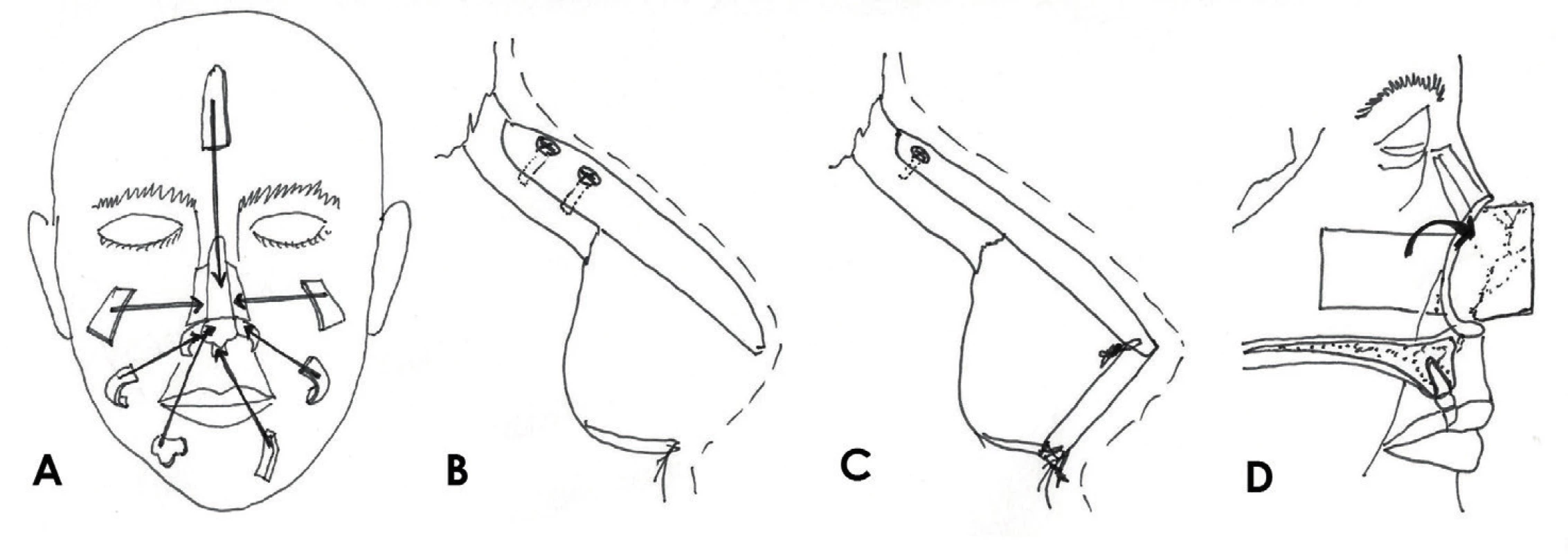 Rekonstukce opěrné struktury nosu: A) jednotlivé chrupavčité a kostěné součásti skeletu, B) konzolový
štěp, C) L-štěp, D) kompozitní pivotální lalok.
Zdroj: Kresba autora podle Thornton JF, Griffin, John R. Nasal Reconstruction. Sel Read Plast. Surg. 2006,
10(12):6-8.