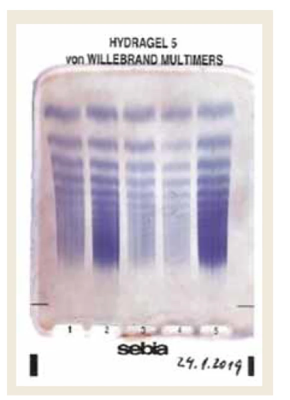 Stanovenie multimérov vWF
na agarózovom géle – materiál autorov.
Pravý prúžok – zdravá kontrola.<br>
Fig. 1. Von Willenbrand factor multimers
determination on agarose gel – authors
archive. Right stripe – healthy control
group.