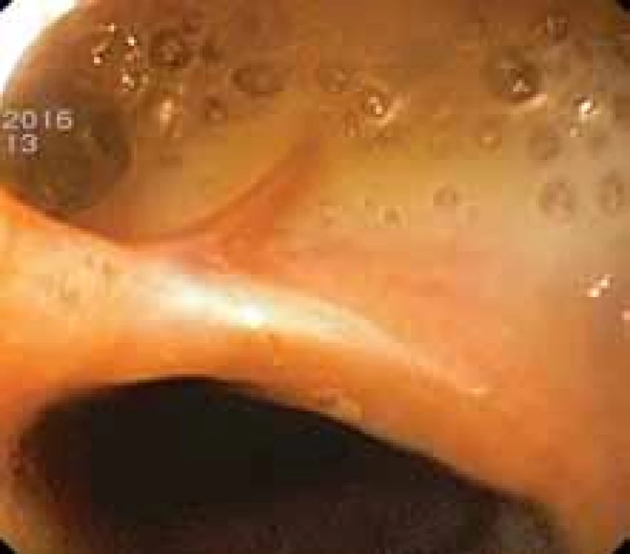 Anastomotic leak in cervical anastomosis following
oesophagectomy.
Obr. 7. Anastomotický leak v krční anastomóze po ezofagektomii.
