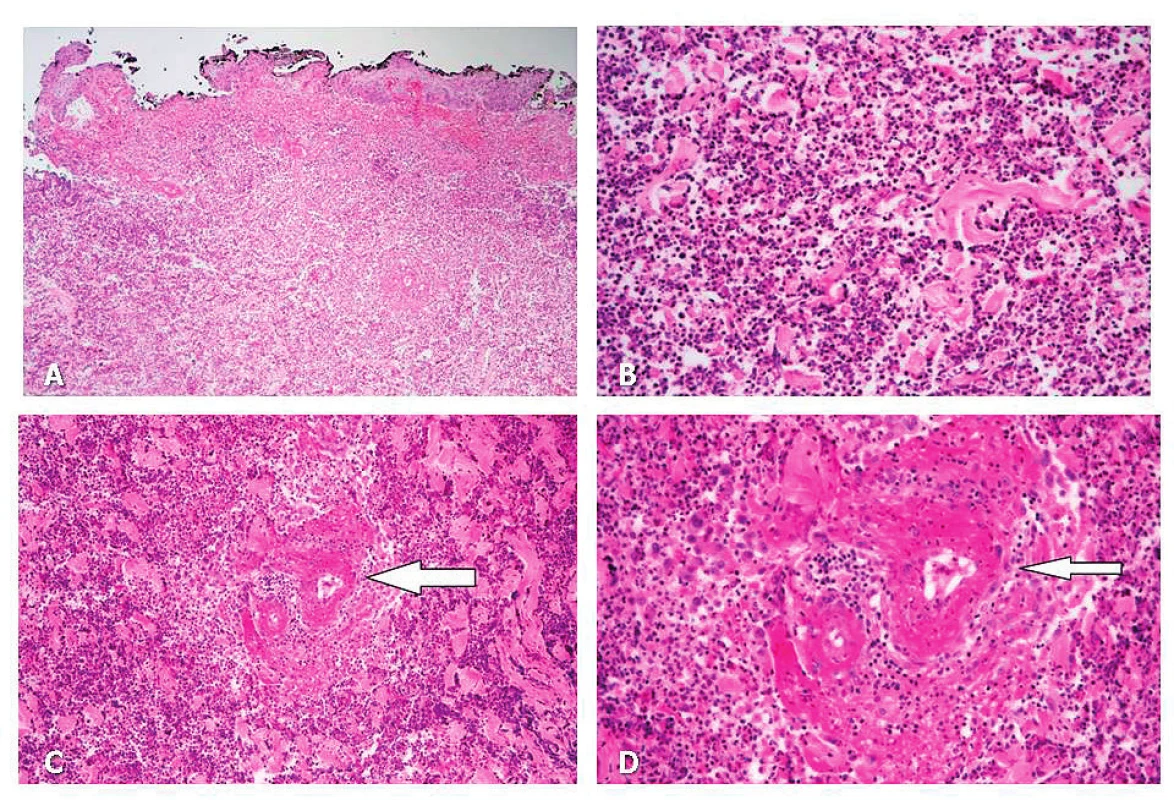 A Masivní zánětlivá infiltrace ve formě flegmony až
gangrény (nekróza tkáně): epidermis zachována jen částečně (HE,
100x).<br>
B Masivní zánětlivá infiltrace dermis – detail na neutrofily (HE,
400x).<br>
C–D Masivní zánětlivá infiltrace ve formě flegmony až gangrény
(nekróza tkáně): uprostřed (šipka) drobná tepna s obrazem
nekrotizující arteritidy (fibrinoidní nekróza stěny a infiltrace
neutrofily). 4C: HE, 200x, 4D: HE, 400x.<br>
Archiv Fingerlandova ústavu patologie, LF UK a FN Hradec Králové.