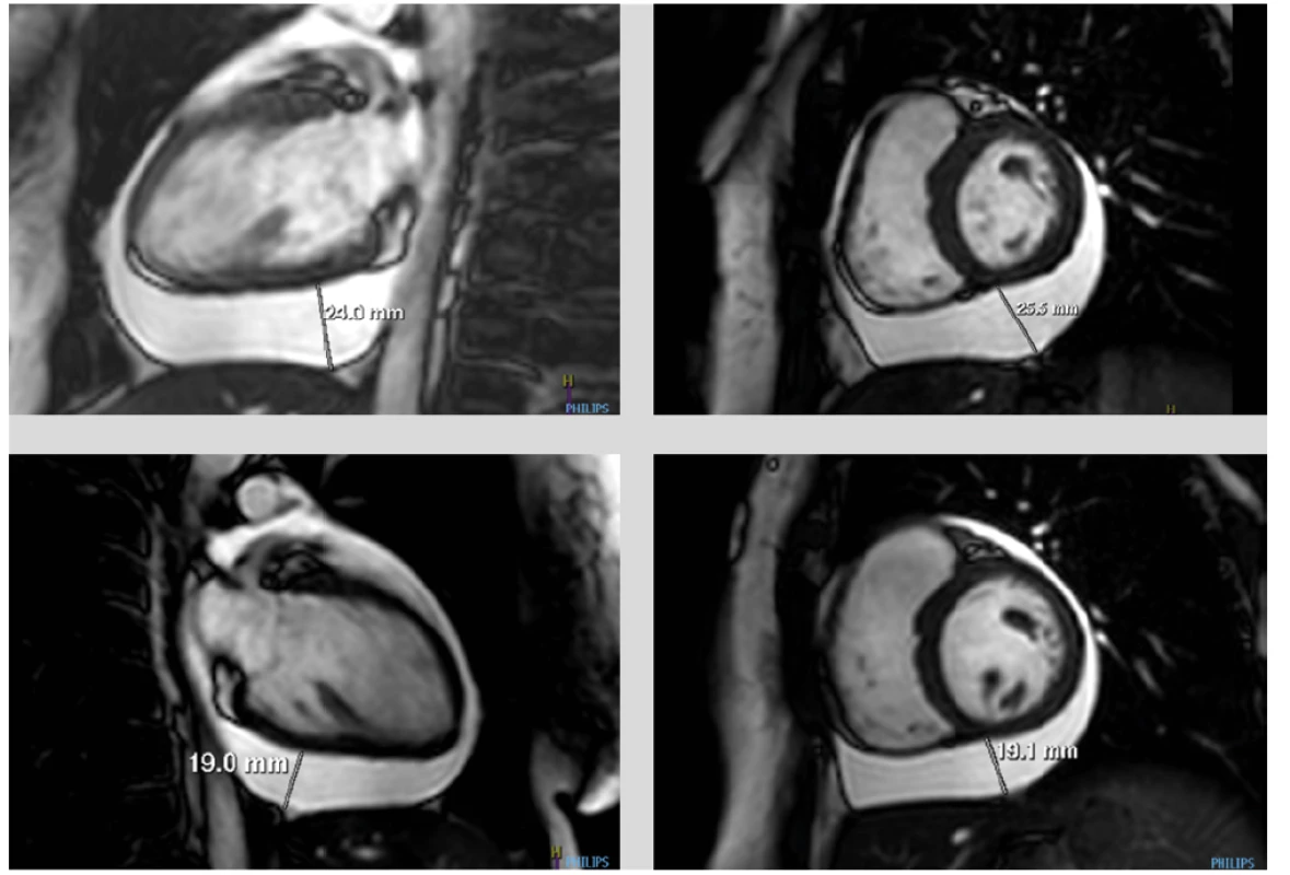 (a, b, c, d) MRI srdce. Dynamické zobrazování ve vertikální dlouhé ose (dvoudutinová projekce) a krátké ose. Patrný perikadiální výpotek s maximem
pod spodní stěnou levé komory při vstupním vyšetření (a, b) a jeho jednoznačná regrese po 2 dnech kortikoterapie (c, d)