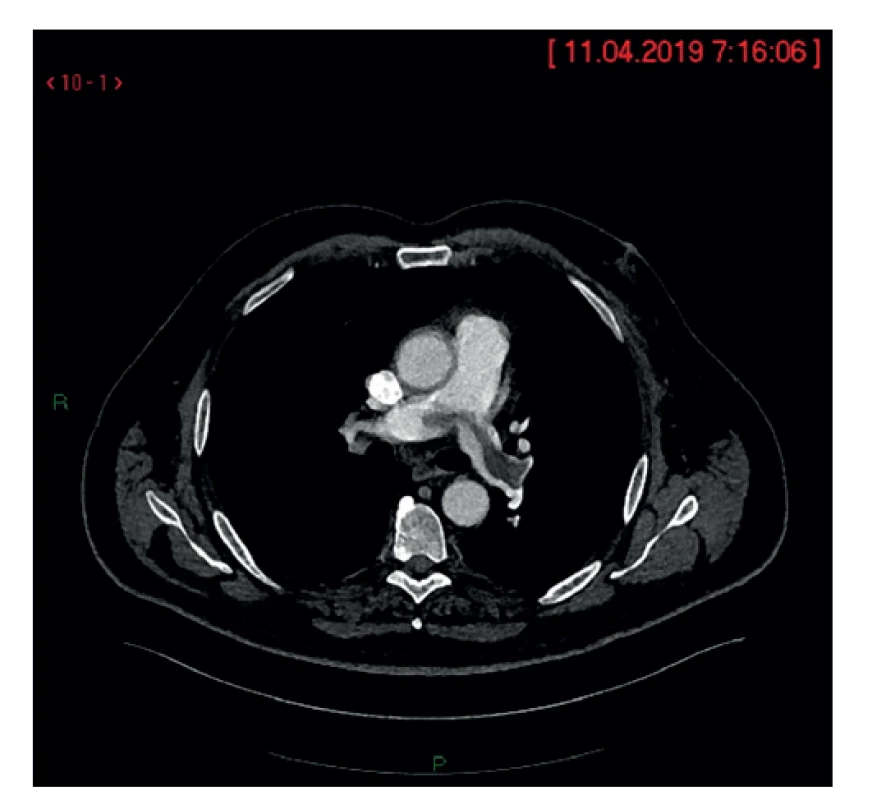 Nádorový embolus vo vetvení pľúcnice<br>
Fig. 7: Fig. 7: Tumor embolus at the branching point of the
pulmonary artery
