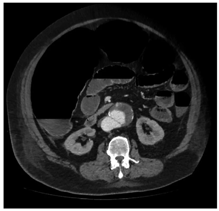 Paralytický ileus a aneurysma abdominální aorty <br>
Fig. 1: Paralytic ileus and abdominal aortic aneurysm