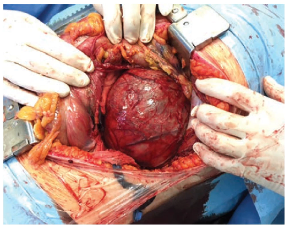 Retroperitoneal tumor extirpation from lumbothomy
approach