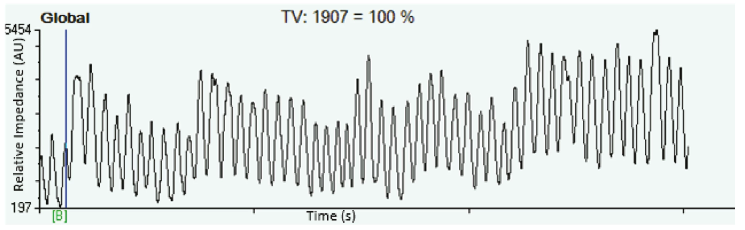 Change of impedance representing the spontaneous breathing of one subject – uncalibrated EIT measurement.