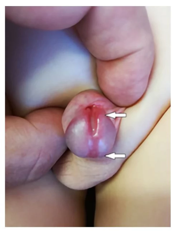 Klinický nález na genitálu u chlapce se zdvojením
typu Effmann II A1; šipkami označeno ortotopické
ústí uretry kaudálně a nadpočetné kraniálně<br>
Fig. 1. Clinical finding in a boy’s genital organ with
an Effmann type II A1 duplication. The arrows indicate
the orthotopic urethral meatus caudally and an
accessory one cranially