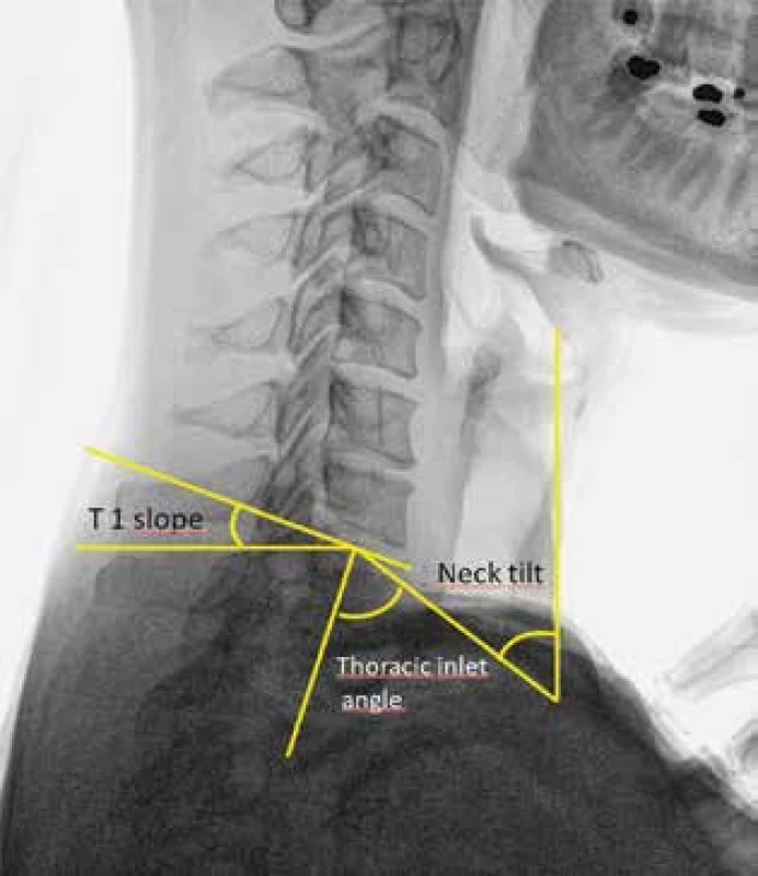 Parametry C-Th přechodu I<br>
Fig. 4: Parameters of the cervical-thoracic junction I