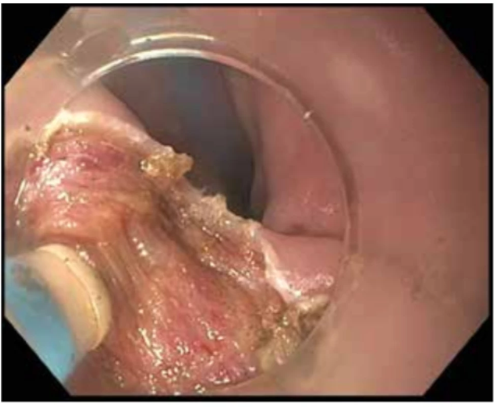 Endoskopická myotomie Zenkerova divertiklu
Elektrokoagulační řez je veden uprostřed septa pomocí ESD
nože.
Zdroj: Archiv Odd. gastrointestinální endoskopie ÚVN v Praze<br>
Fig. 3: Endoscopic myotomy of Zenker‘s diverticulum
The electrocoagulation incision is guided in the middle of the
septum by the ESD knife.
Source: Archive of the Gastrointestinal Endoscopy Department of the Military University Hospital in Prague