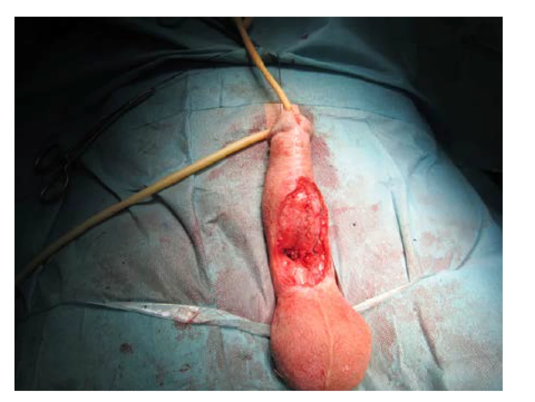 Dokončená sutura s tubulizací neouretry<br>
Fig. 18. Completed suture with tubularization of the
neourethra