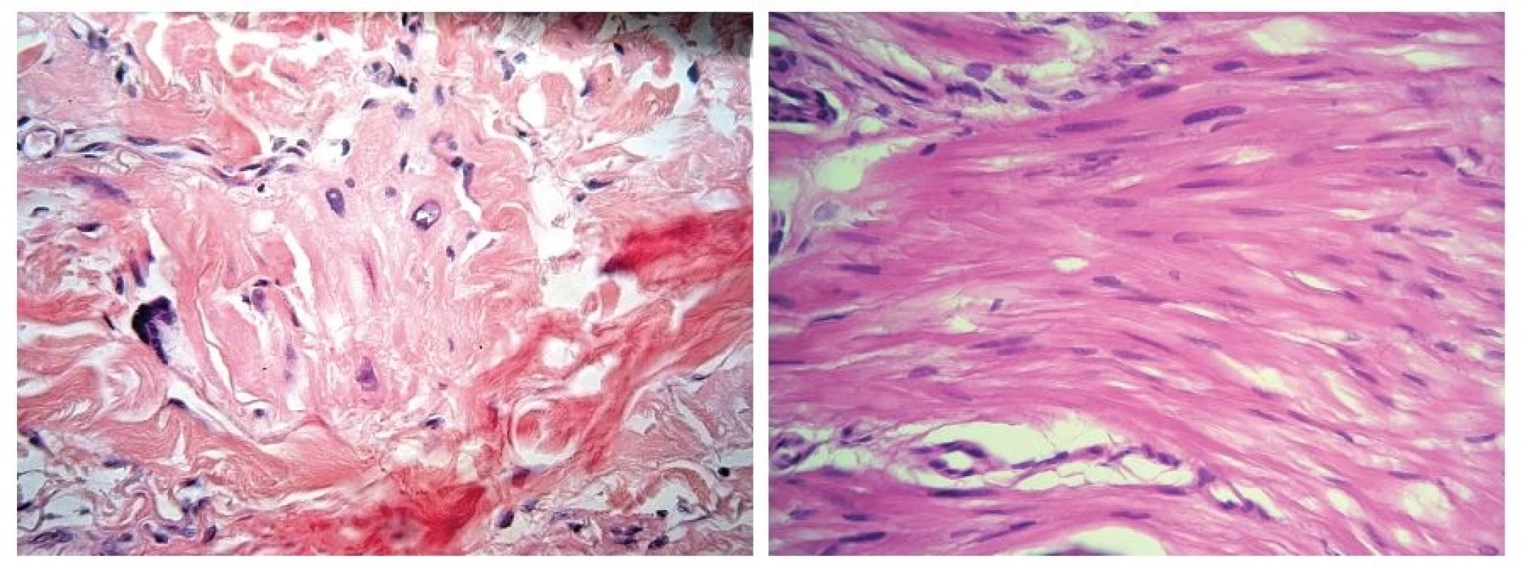 a, b. Místy mají buňky hyperchromní pleomorfní jádra (a), místy jsou vřetenitého charakteru (b)