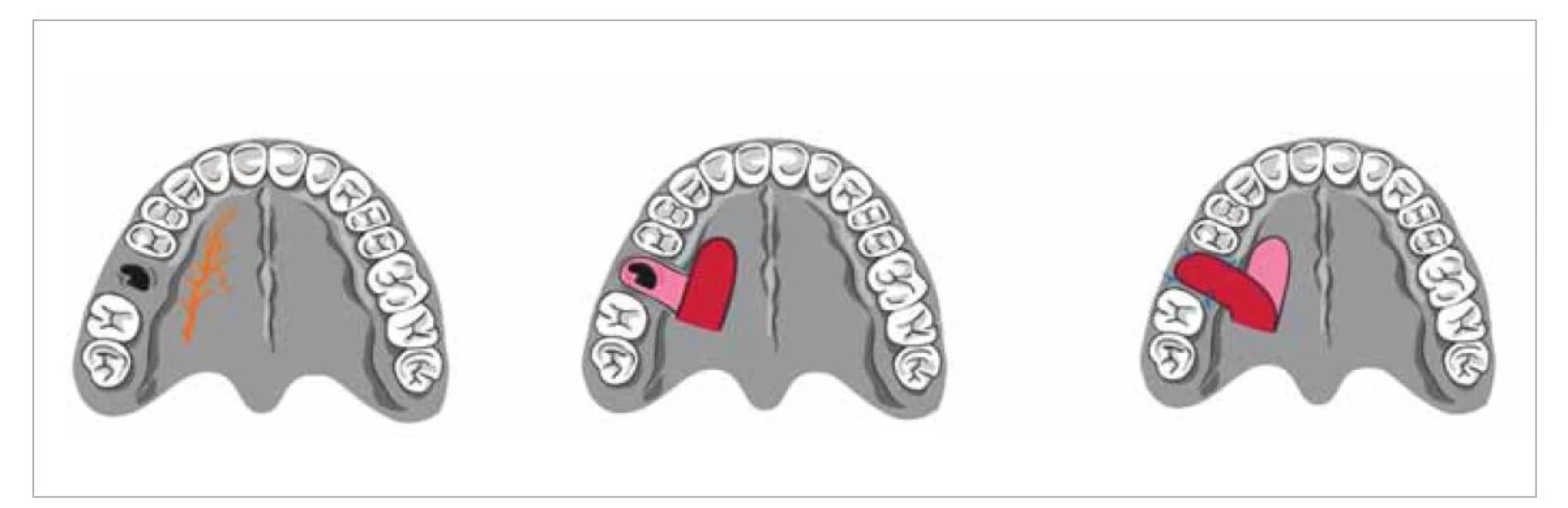 Patrový lalok.<br>
Fig. 4. Palatal flap.