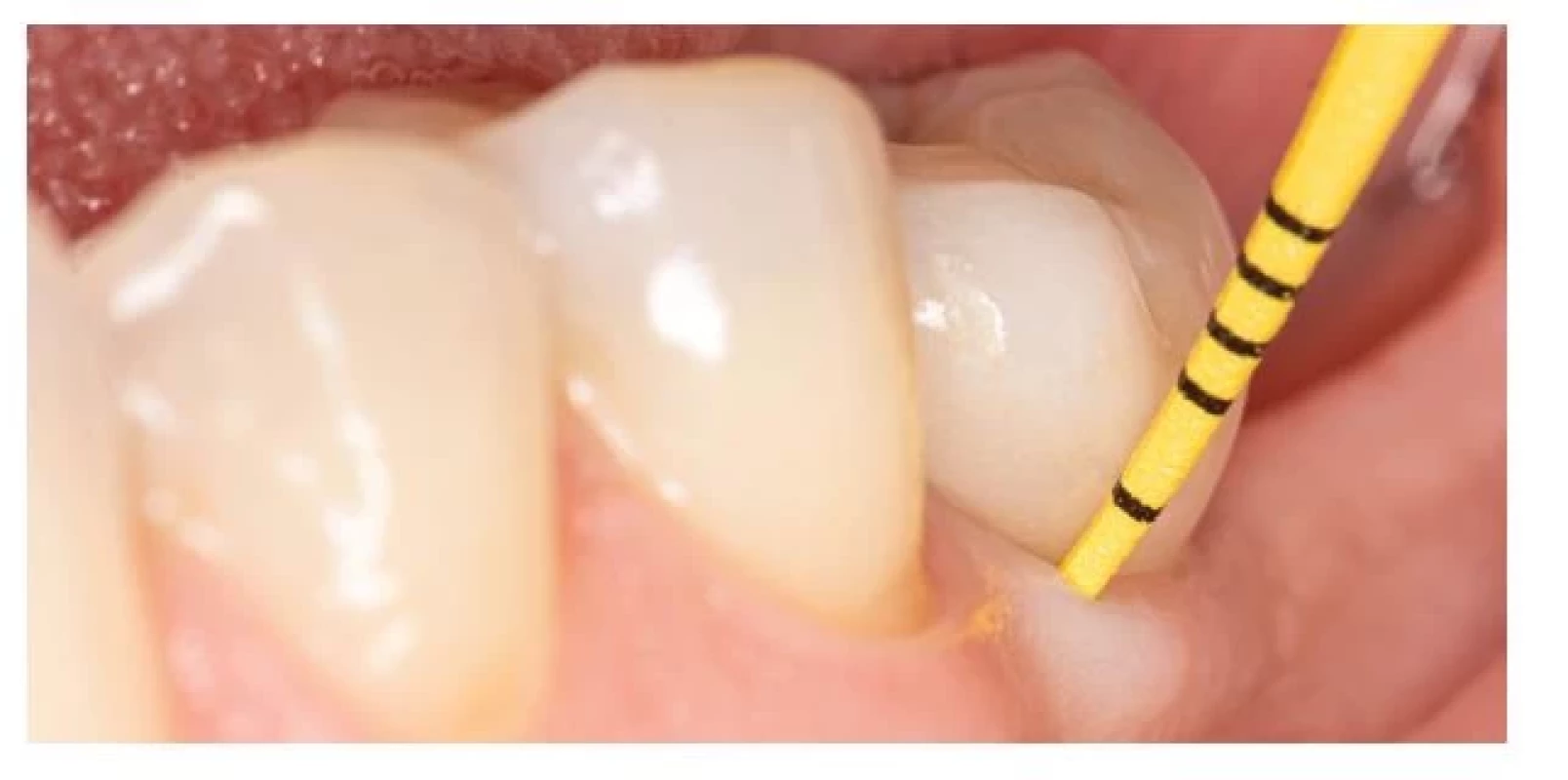 Klinické vyšetrenie pomocou
plastickej parodontálnej
sondy.<br>
Fig. 5
Clinical examination using
plastic periodontal probe.