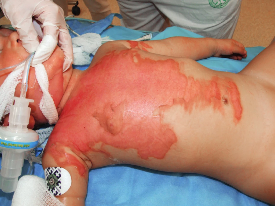 A 15-month-old boy admitted due to superficial seconddegree
burns over 20% of total body surface area