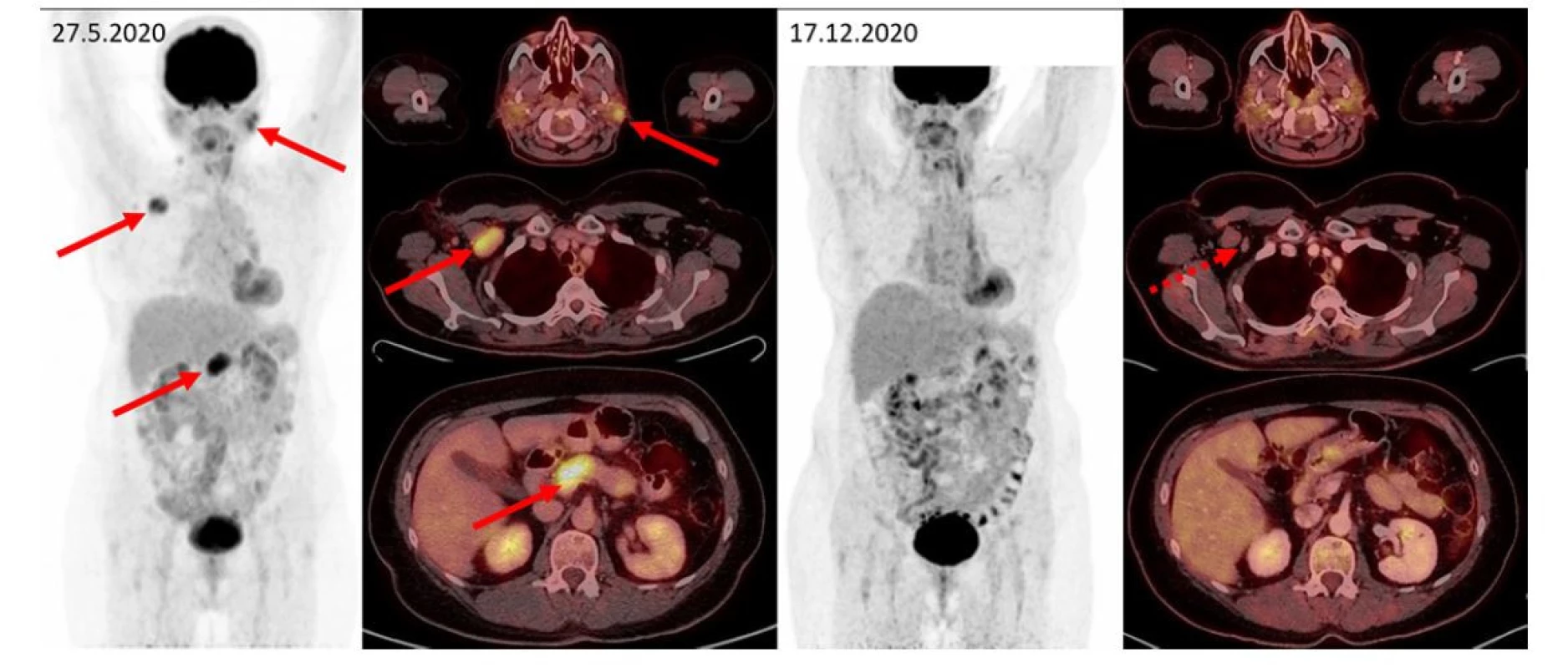 F–FD6 PET/CT vyšetření u pacientky s bolestmi v dolní polovině břicha a zvětšením pankreatu. Šipkami jsou označeny metabolicky aktivní infiltrace
příušních slinných žláz, zvětšená aktivní uzlina vpravo pod prsními svaly, infiltrace přechodu hlavy a těla pankreatu. Další méně výrazná ložiska
(vlevo v gll. submandibularis, uzlinách na krku, kaudě pankreatu) jsou patrna na MIP zobrazení, ale nejsou označena. Tato metabolicky aktivní ložiska
při kontrolním vyšetření zanikají, drobné reziduum bez zvýšené metabolické aktivity je patrné jen vpravo subpektorálně. Pacientka měla dva cytologické
odběry z pankreatu, jeden vyšel jako zánět, druhý jako adenocarcinom. Vymizení infiltrace po léčbě rituximabem, cyklofosfamidem a dexametazonem
potvrdilo etiologii v IgG4-RD a vyloučilo adenokarcinom pankreatu, který by na tuto léčbu nereagoval