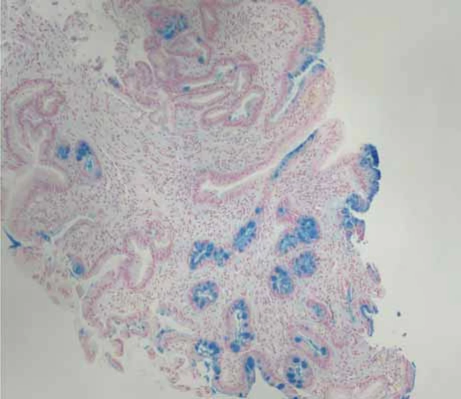 Přechod dlaždicobuněčného epitelu jícnu a žlázového epitelu žaludku
se známkami intestinální metaplasie, barvení alciánovou modří.<br>
Fig. 5. Transition of squamous epithelium of esophagus and glandular epithelium
of stomach with signs of intestinal metaplasia, staining with alcian blue.