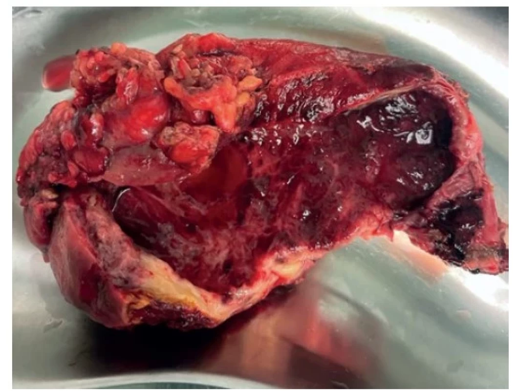 Peroperační snímek − rozstřižený žlučník se ztluštělou
stěnou a sliznicí s ulceracemi<br>
Fig. 3. Perioperative picture − the opened gallbladder
with wall thickening and mucosal ulcers