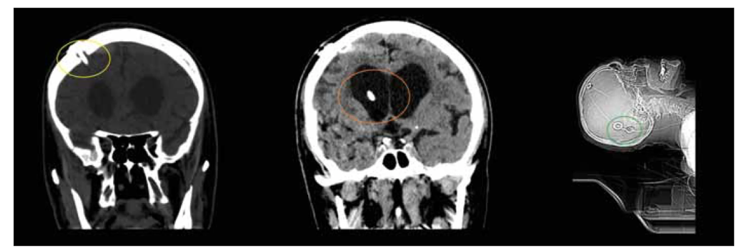 CT, frontální a sagitální rovina. Pacient den po implantaci ventrikuloperitoneálního zkratu. Povšimněte si pozice návrtu (žlutý
kruh) a ventrikulárního katétru (oranžový kruh) při implantaci ventrikulárního katétru z Kocherova bodu. Důležité je dosáhnout paralelní
polohy s podélnou osou těla při implantaci gravitačních ventilů (zelený kruh).<br>
Fig. 9. CT, coronal and sagittal plane. Patient on the day after the implantation of ventriculoperitoneal shunt. Note the positions of the
burrhole (yellow circle) and ventricular catheter (orange circle) when implanting the ventricular catheter from the Kocher point. It is
important to achieve a position parallel to the longitudinal axis of the body when implanting gravity valves (green circle).