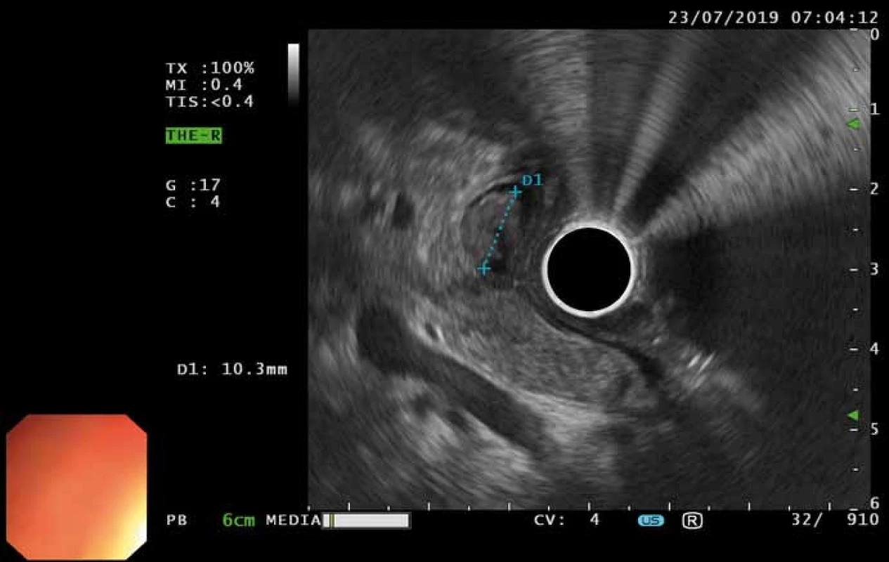 Endosonografi e – izoechogenní laločnaté ložisko rozměru 10 × 10 mm
v terminálním úseku d. choledochus.