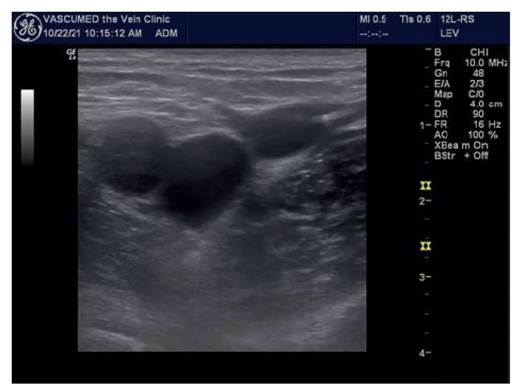 Laserové vlákno excentricky uložené v lumen žíly
naléhající na přední stěnu VSM před SFJ<br>
Fig. 5: Laser fiber eccentrically placed in the lumen of the
vein adjacent to the anterior wall of the GSV in front of
the SFJ