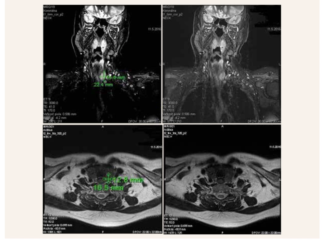 MRI-vyšetrenie krku (2016). Na T1 koronárnych sekvenciách (TIRM) je patrný hypersignálny uzol v ľavom laloku
štítnej žľazy, ktorý bol pôvodne mylne považovaný za primárny uzol štítnej žľazy. Neskôr sa však ukázalo,
že sa jedná o intraparenchýmovo uložené zväčšené prištítne teliesko, ktoré bolo infiltrované karcinómom PT.<br>
Dolné dva obrázky zobrazujú tento uzol v transverzálnej rovine v T2 váženej sekvencii (TSE sekvencia)