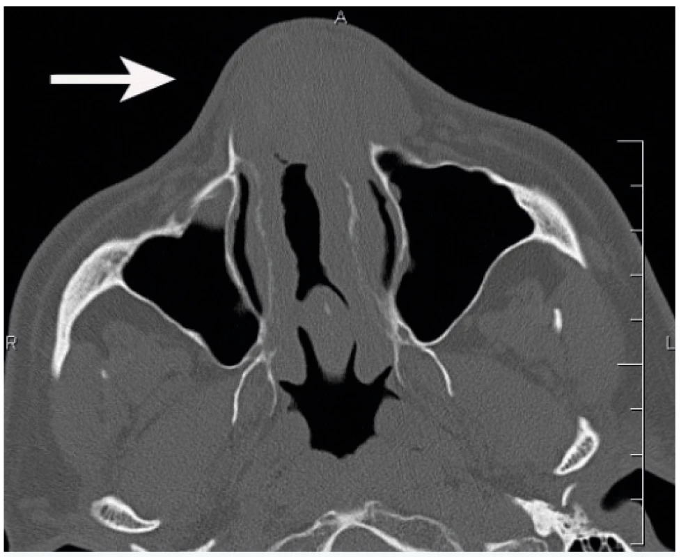 Computed tomographic axial scan showing a softtissue,
expansive lesion in the frontal part of the nasal cavity
(arrow)