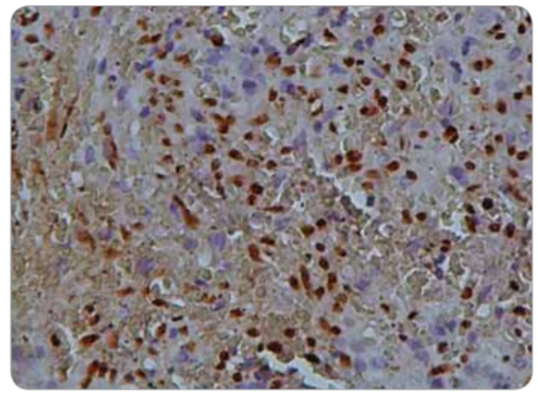  Positive immunoreactivity for human herpes virus 8. 
