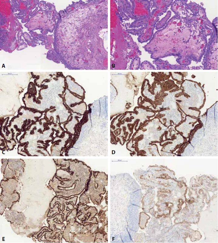 Nefrogenní adenom - papilární struktury kryté jednou vrstvou kubického epitelu (A) s typickým “cvočkovitým/hobnail” vzhledem (B). Léze je pozitivní v imunohistochemickém průzaku CK7 (C), CK20 (D), PAX8 (E) a v racemáze/AMACR (F).